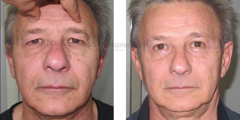 liftingsopracciglio_slide_01