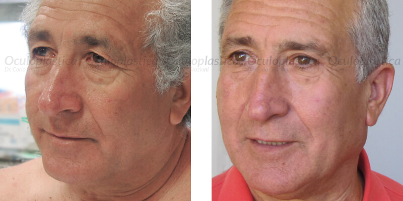 liftingsopracciglio_slide_03