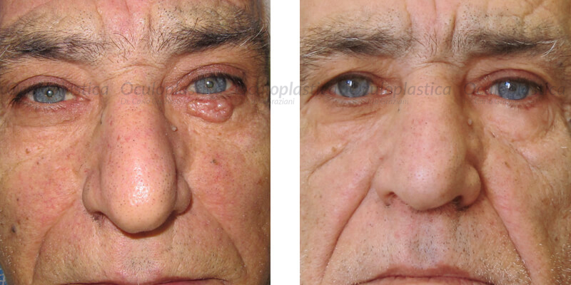 pre e post tumore palpebrale