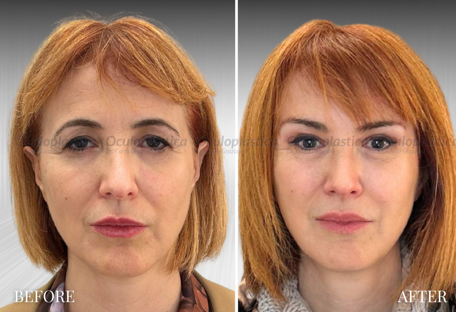 Prima Dopo Lifting Sopracciglio Blefaroplastica 2.0 Prima Dopo Lifting Sopracciglio Blefaroplastica 2.0