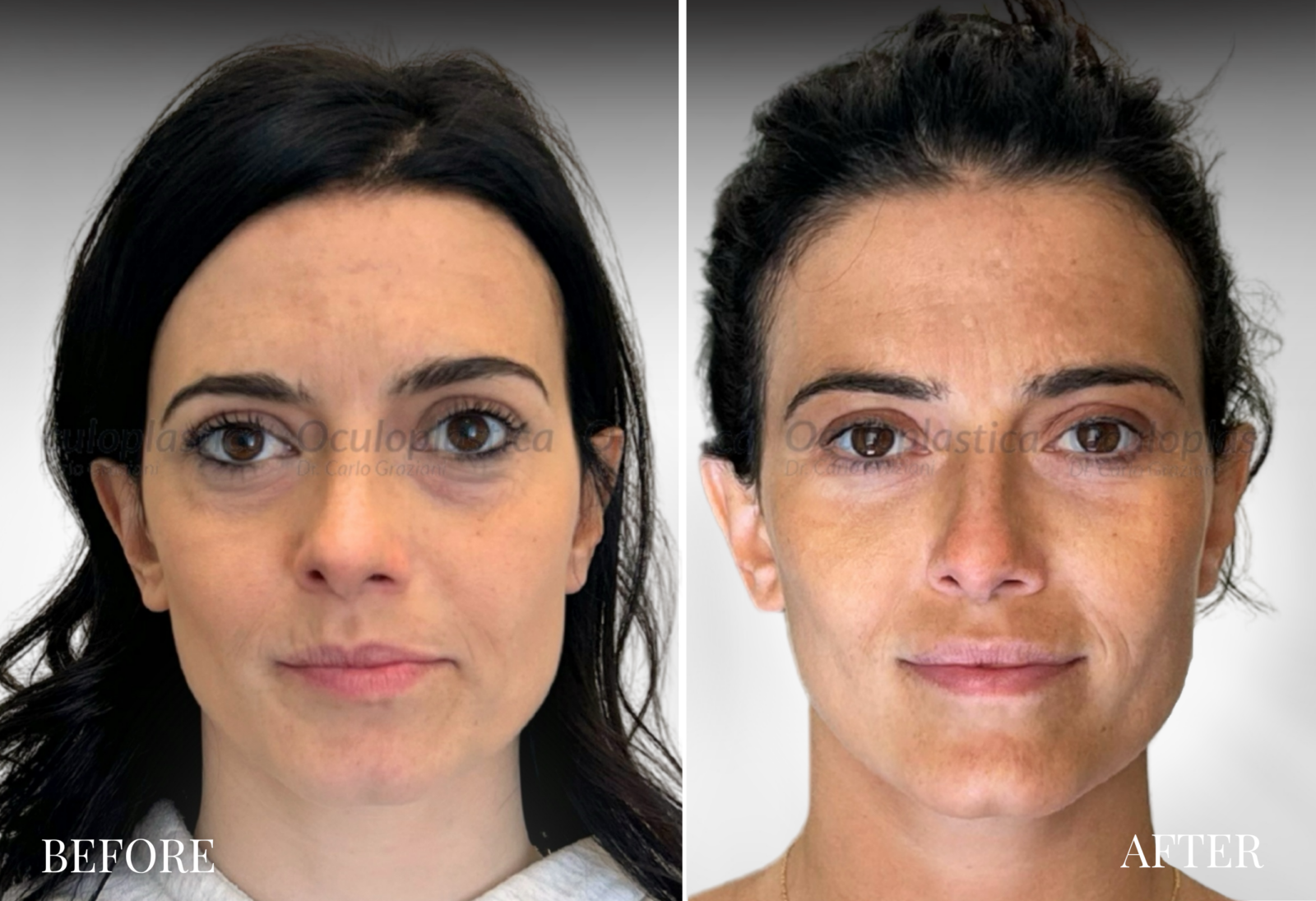 Prima Dopo filler palpebre inferiori orbita laterale occhiaie cerchi scuri