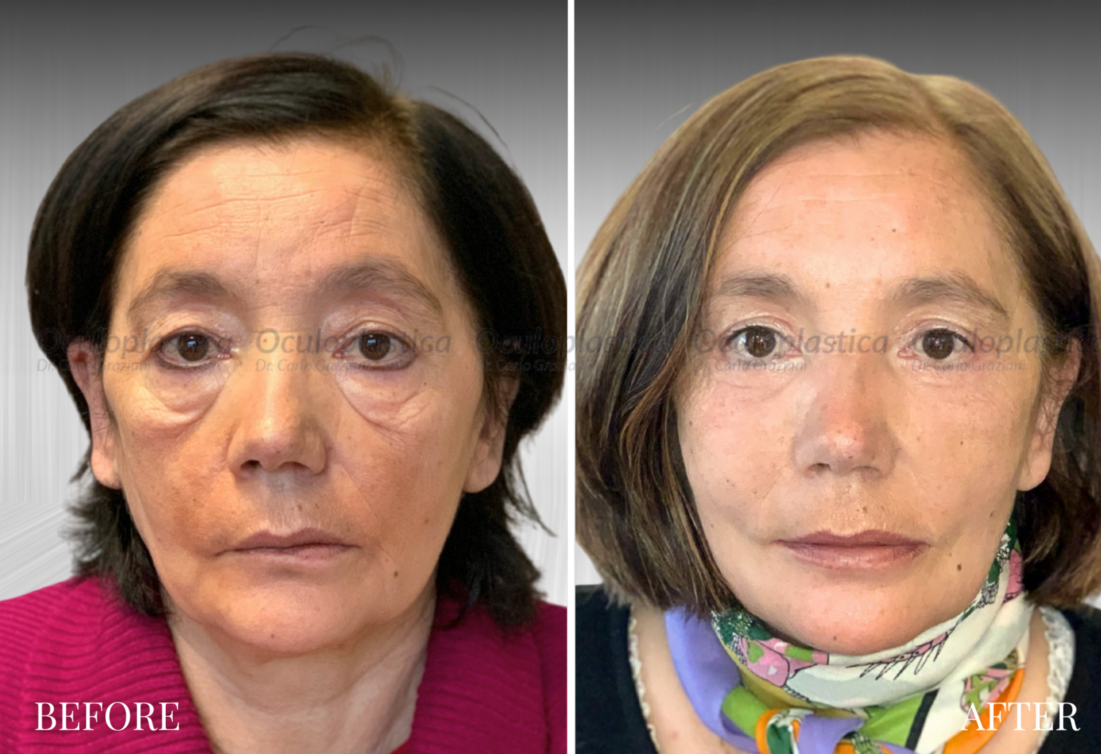 Prima dopo lifting malare viso palpebre