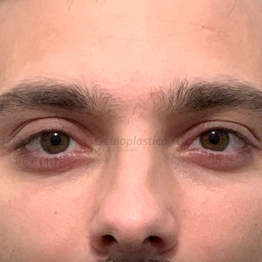 occhio incavato
