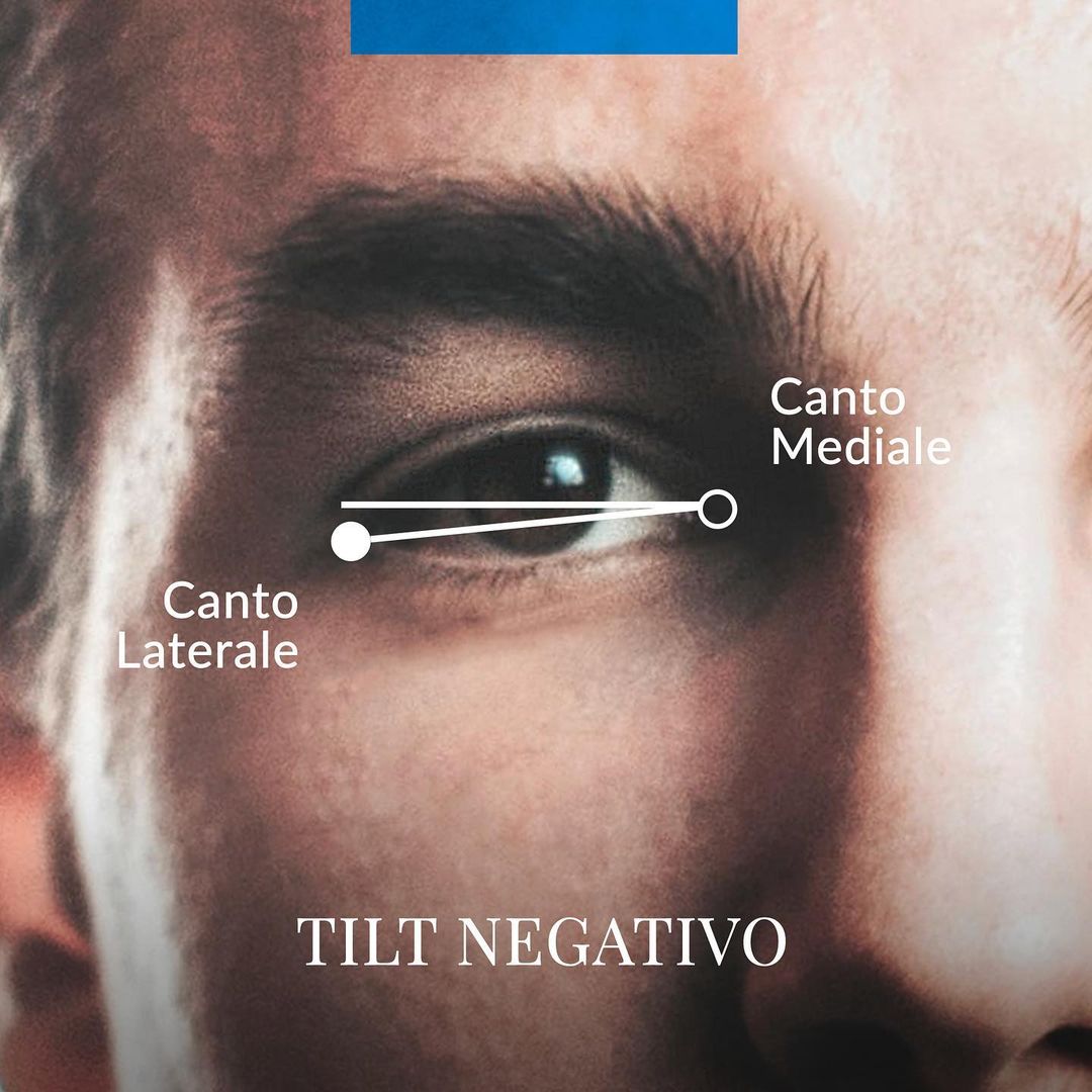 tilt negativo cantoplastica