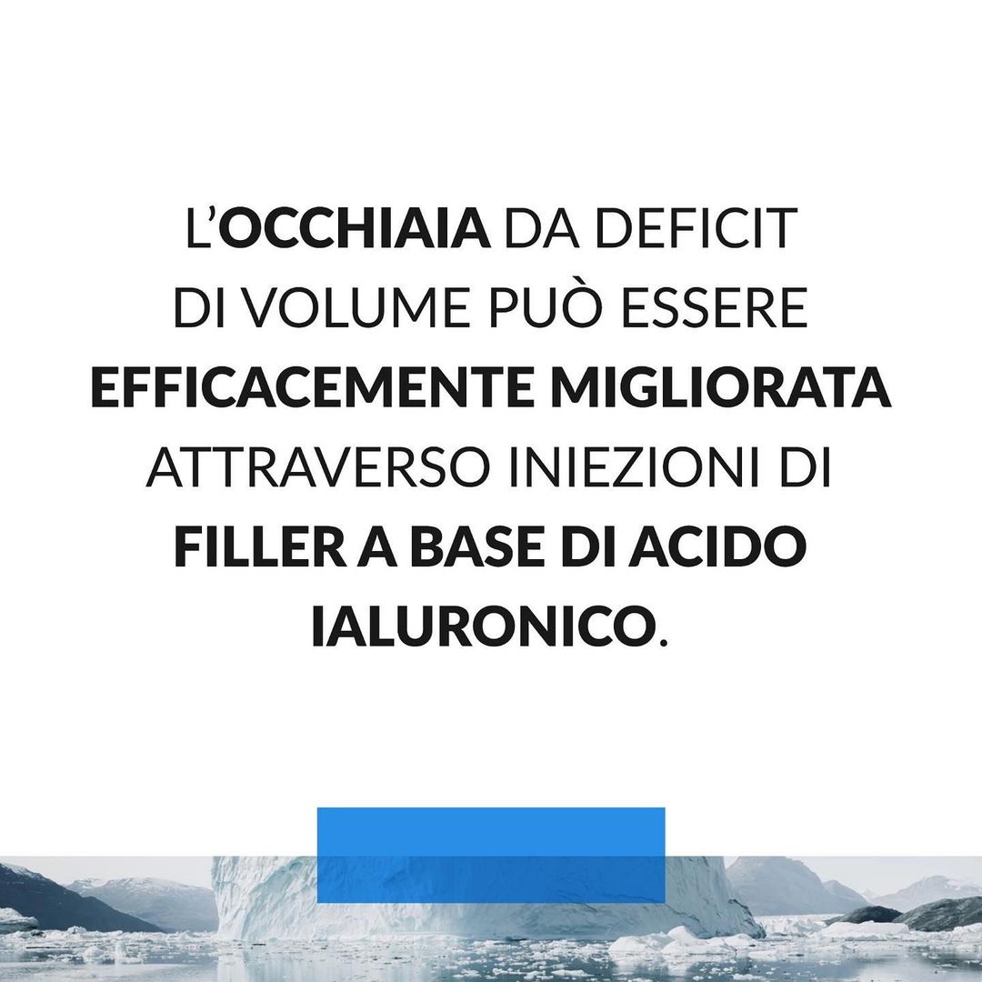 trattamento occhiaia da deficit con filler acido ialuronico