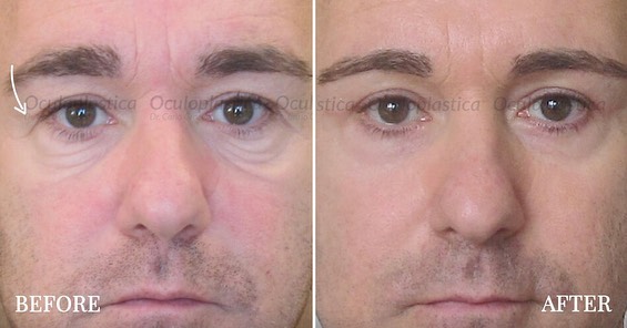 Before-after blepharoplasty surgery