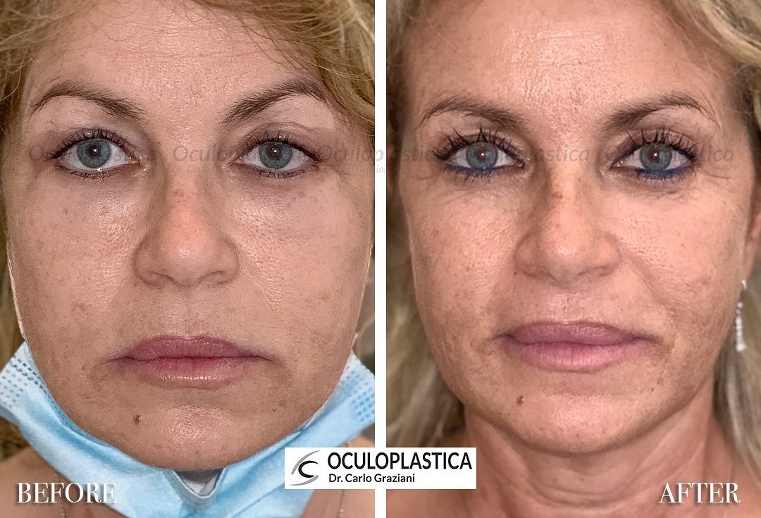 Before-after trattamento Ialuronidasi