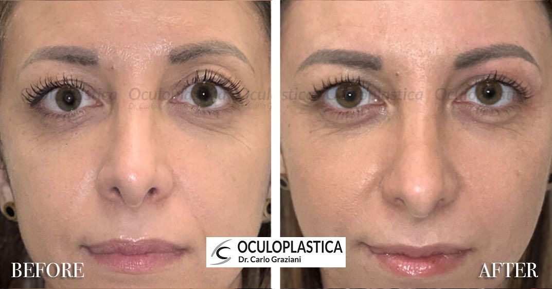 Treatment of upper eyelids with hyaluronic acid-based fillers