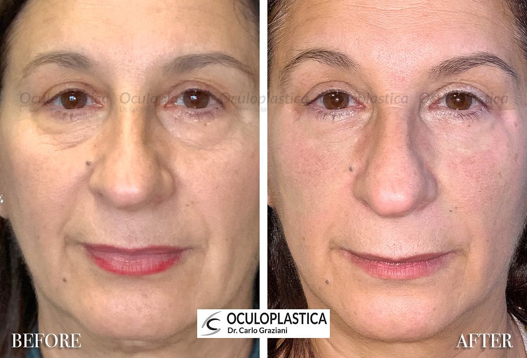 Treatment with hyaluronic acid-based fillers