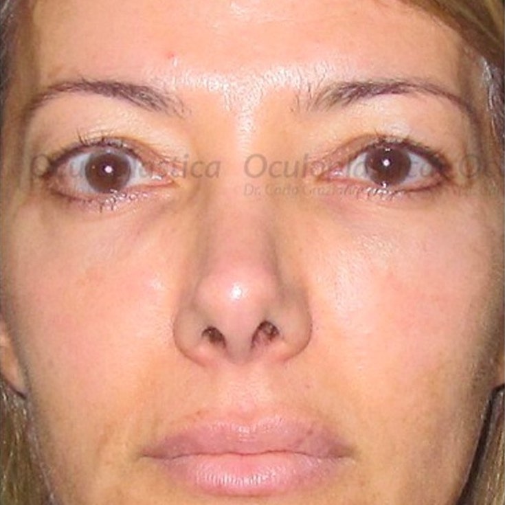 eyelid retraction