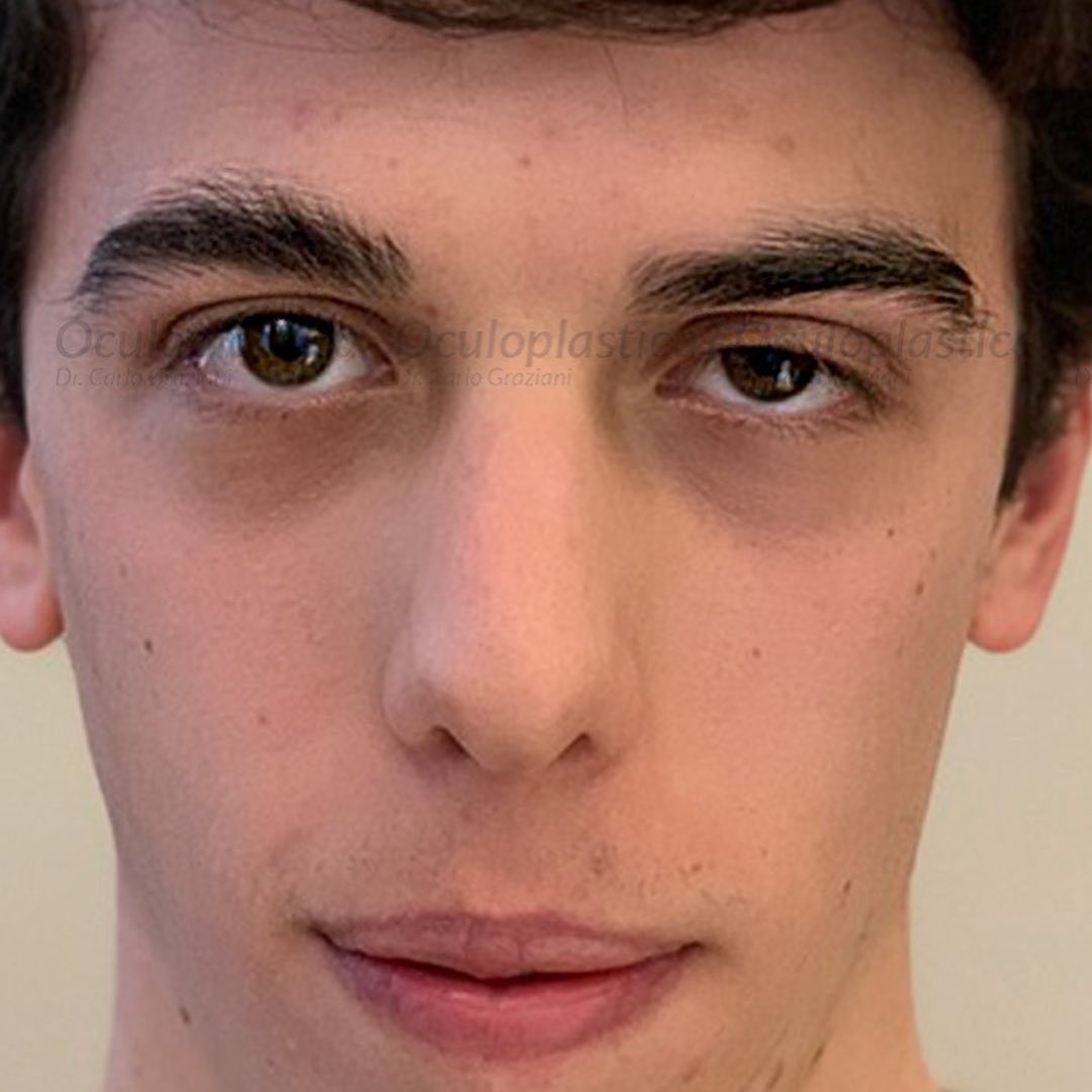 ptosipalpebral unilateral