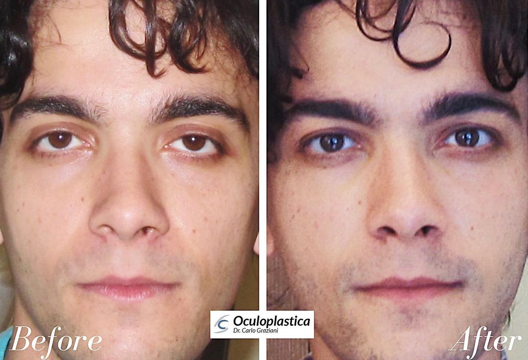 before-after-ptosi-hunter-eyes