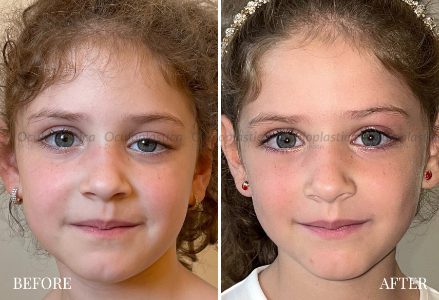 Before-After-ptosi-palpebrale-congenita