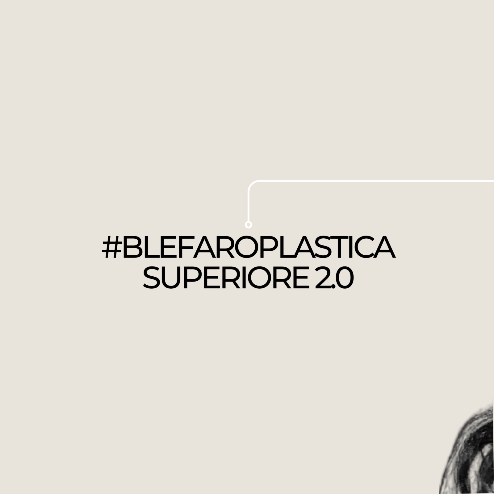 Blefaroplastica superiore 2.0
