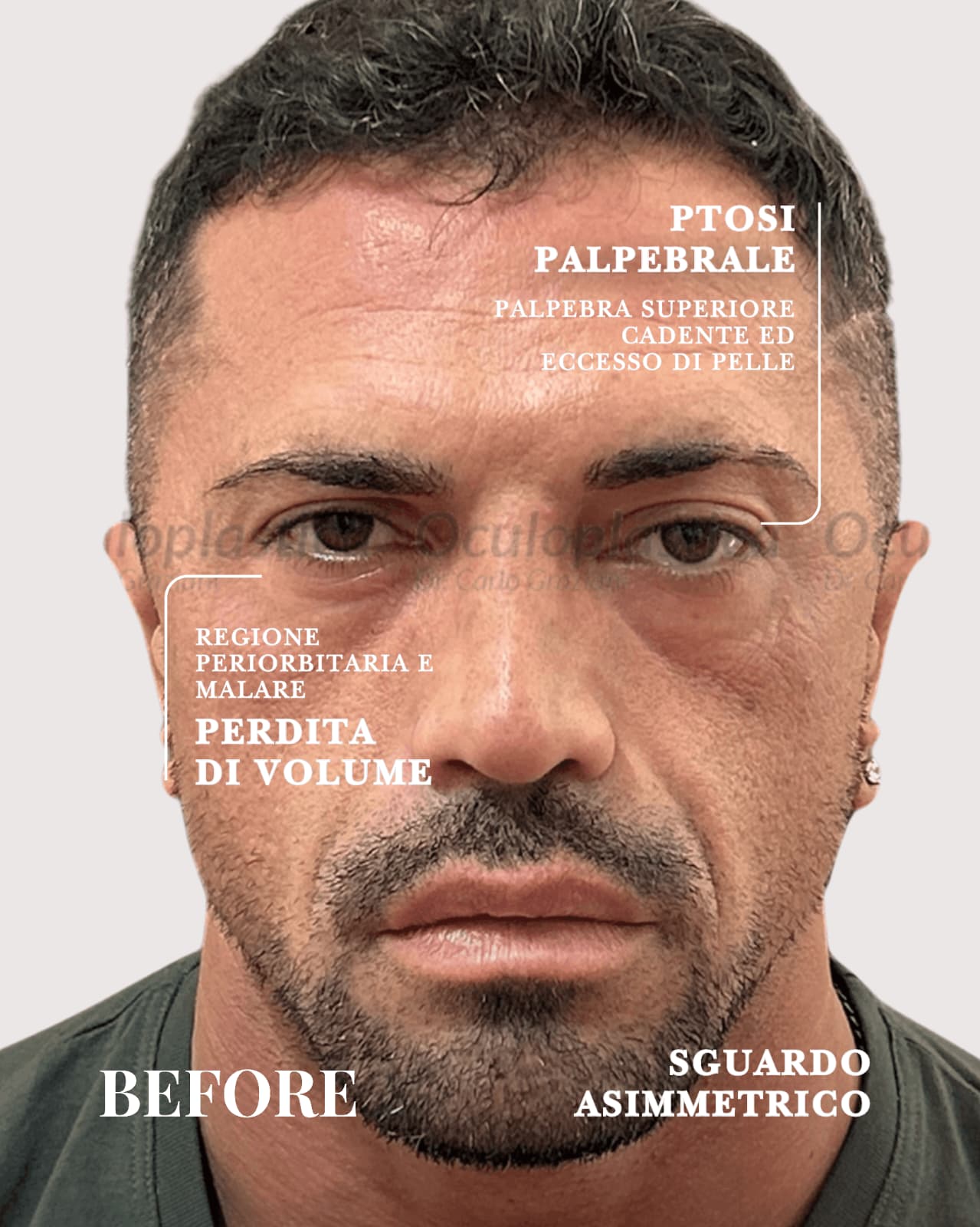 Prima Dopo Bleph 2.0, Lifting Palpebrale, Ptosi palpebrale