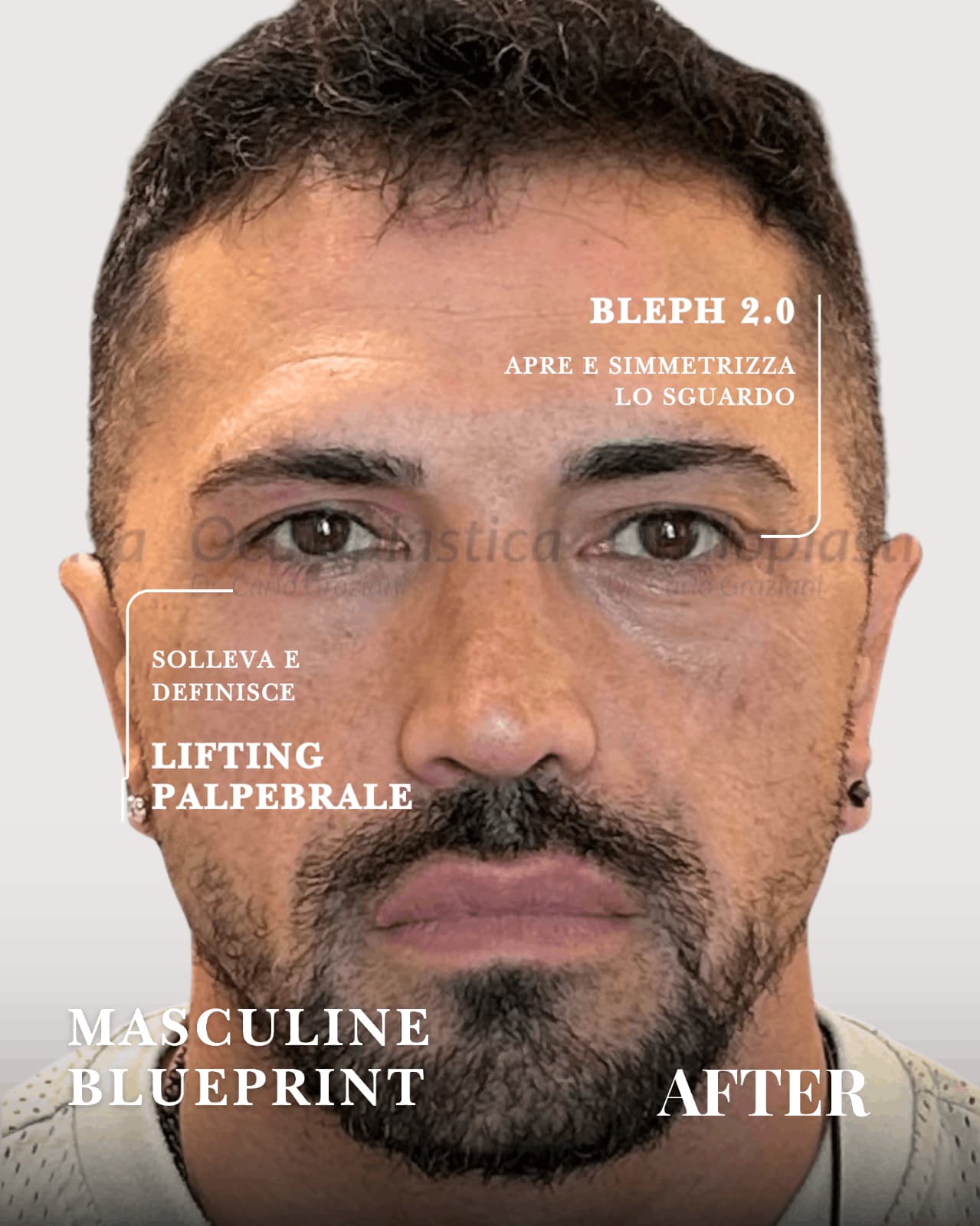 Prima Dopo Bleph 2.0, Lifting Palpebrale, Ptosi palpebrale