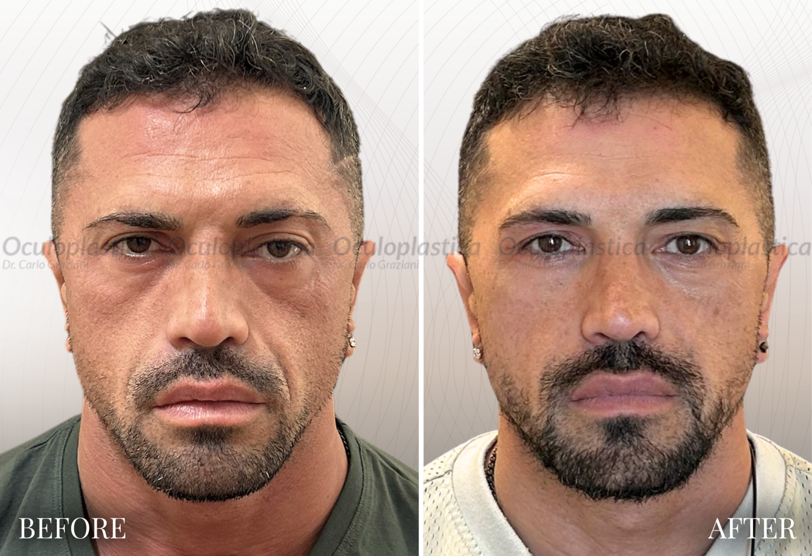 Prima Dopo Bleph 2.0, Lifting Palpebrale, Ptosi Palpebrale