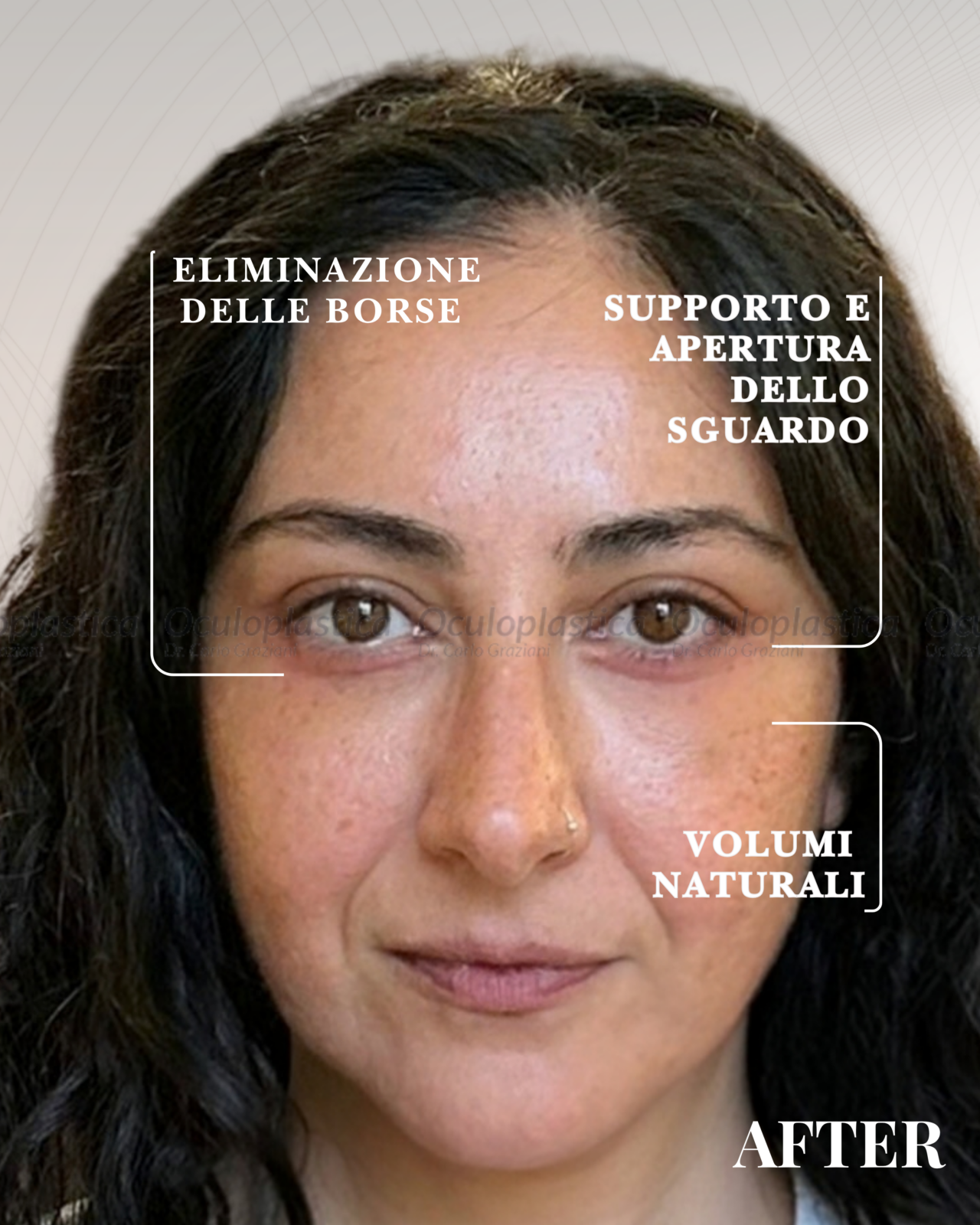PRIMA DOPO LIFTING MALARE, CANTOPLASTICA E LIPOFILLING