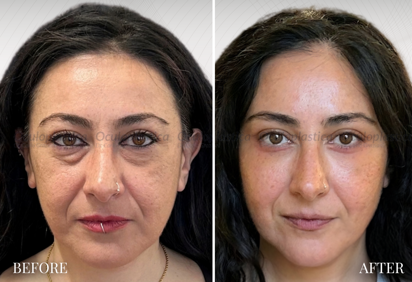 PRIMA DOPO LIFTING MALARE, CANTOPLASTICA E LIPOFILLING