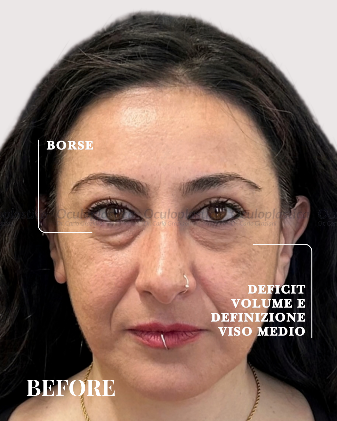 PRIMA DOPO LIFTING MALARE, CANTOPLASTICA E LIPOFILLING