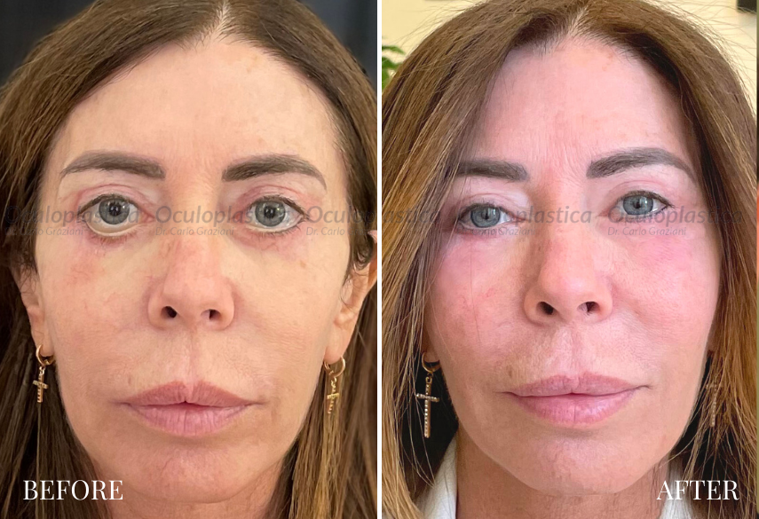 Before After Risoluzione Con Malar Lift Complicanza Post Blefaroplastica