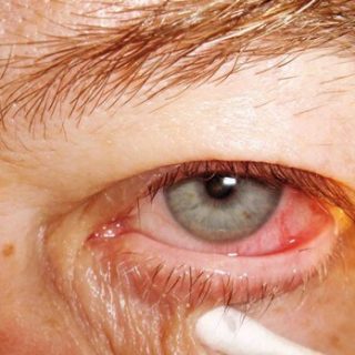 Trichiasi, distichiasi, ciglia aberranti