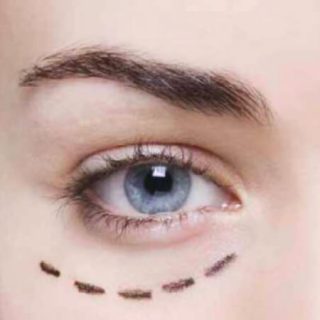 Come eliminare le borse palpebrali senza avere cicatrici visibili