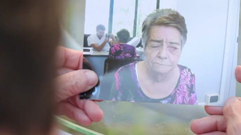 Paralisi facciale | Paresi facciale