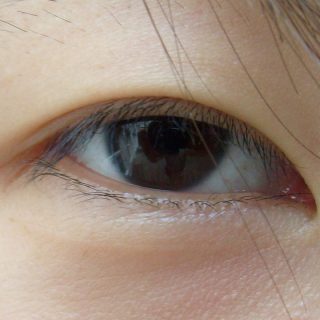 Epicanto o strabismo? Come riconoscere il problema Epicanto o strabismo? Come riconoscere il problema