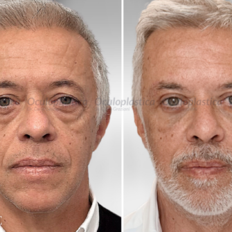 Prima Dopo Lifting Sopracciglio EyeDefine Lyft Blefaroplastica inferiore Lipofilling Prima Dopo Lifting Sopracciglio EyeDefine Lyft Blefaroplastica inferiore Lipofilling