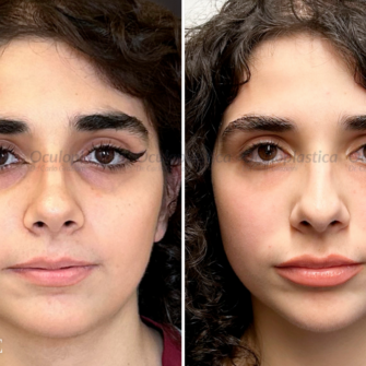 Prima Dopo Nanolipofilling Occhiaie Cerchi Scuri