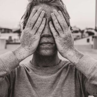 Quali sono i sintomi del tumore della palpebra superiore