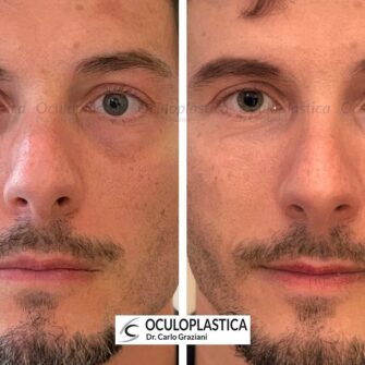 Prima dopo filler orbita laterale occhiaie Prima dopo filler orbita laterale occhiaie