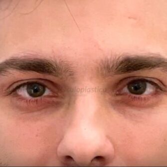 Prima dopo filler palpebra superiore hunter eyes uomo Prima dopo filler palpebra superiore hunter eyes uomo