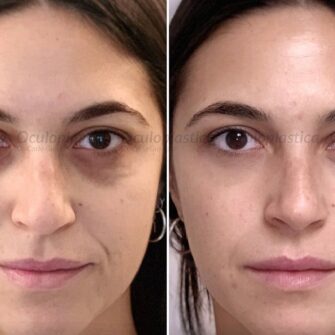 Prima dopo filler occhiaie cerchi scuri Prima dopo filler occhiaie cerchi scuri