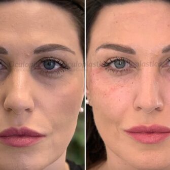 Antonella dark circles treatment