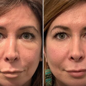 Before- After complication from filler