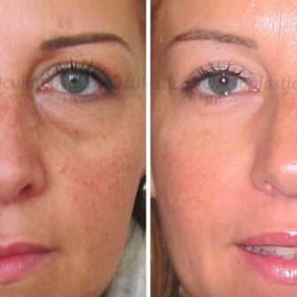 Before-after blepharoplasty