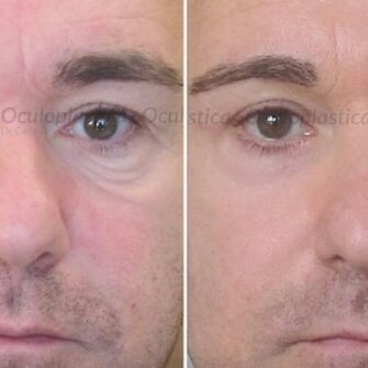 Before-after blepharoplasty surgery
