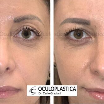 Prima dopo filler palpebra superiore Prima dopo filler palpebra superiore