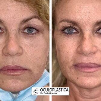 Prima dopo ialuronidasi complicanza filler Prima dopo ialuronidasi complicanza filler