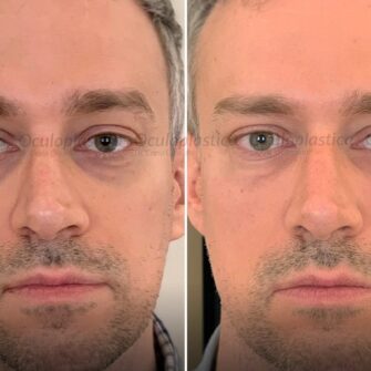 Gian Paolo dark circles treatment