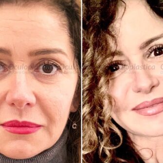 Greta Blepharoplasty ptosis