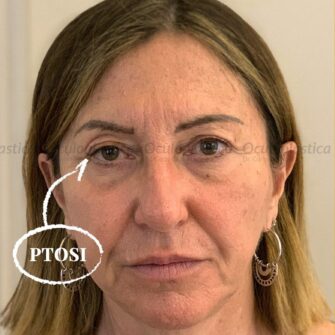 Greta blepharoplasty