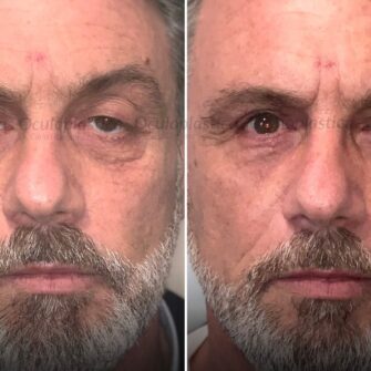 Prima dopo ptosi palpebrale uomo asimmetria