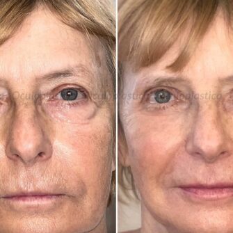 blepharoplasty and ptosis surgery
