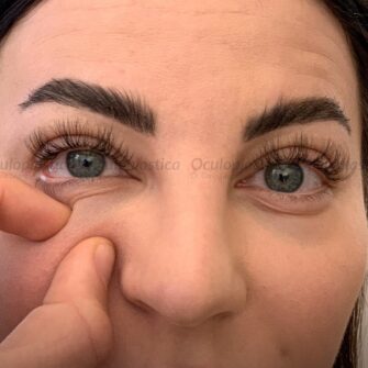 complication from filler