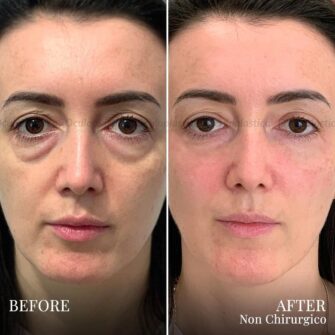 Prima dopo filler borse sotto gli occhi