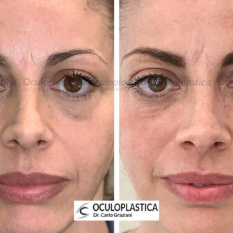 Dark circles hyper pigmented