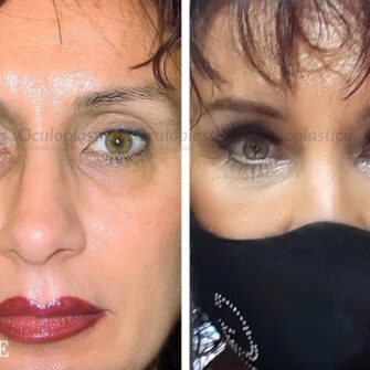 Eyeframe ptosis blepharoplasty